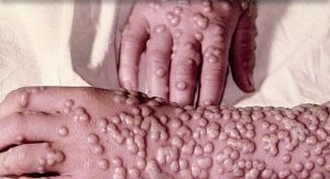 Smallpox is highly infectious, with a distinctive rash that changes in appearance as the disease progresses. - Courtesy Joseph Bennington-Castro, medically reviewed by Sanjay Sinha, MD in Everyday Health Newsletter November 17, 2021